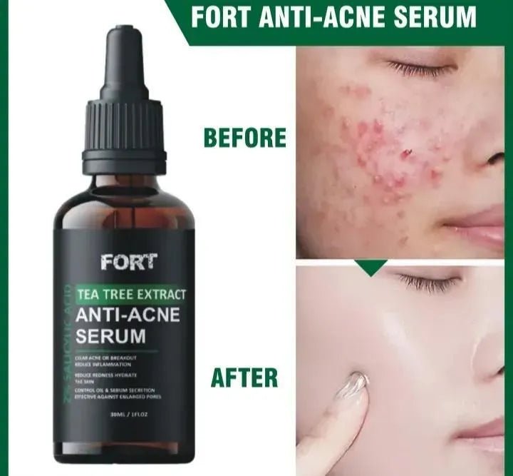 Anti Acne Face Serum for Clear & Glowing Skin – Oil Control Tea Tree Serum 30ml - MK Fashionclub